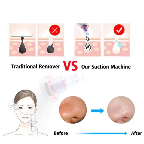 Blackhead Suction Tool